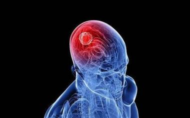 奪走王寶強媽媽的腦瘤是種什么病？腦瘤有10個早期癥狀