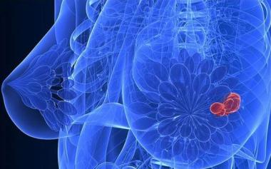 警惕！乳腺癌術后有兩個復發高峰期！日常如何預防？