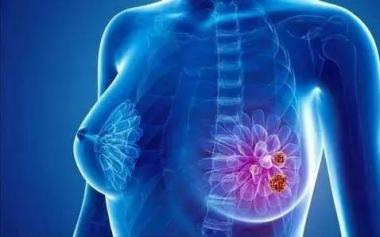 新冠肺炎疫情期間，乳腺癌患者如何治療與預防？