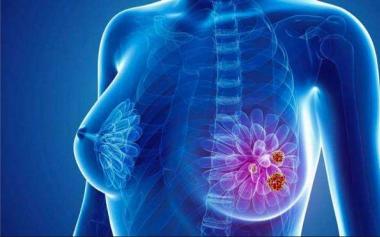 緊張備考錯過早診機會，18歲女生高考前查出乳腺癌！