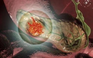 七旬奶奶突發腹痛一查竟是胰腺癌！胰腺癌早期難察覺