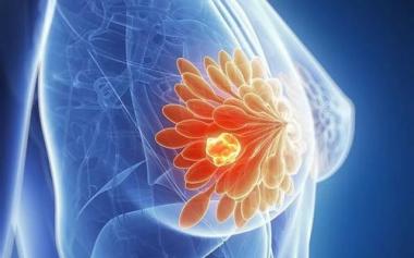 女性乳腺癌成為全球確診數(shù)量最多的癌癥！誰是高危人群？