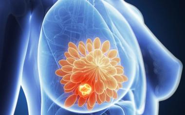 知道嗎？很多乳腺癌是吃出來的！這六類女性尤其小心